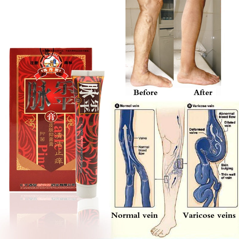 Natural Varicose & Spider Veins Removal Cream