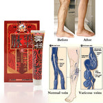Natural Varicose & Spider Veins Removal Cream