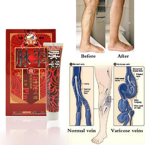 Natural Varicose & Spider Veins Removal Cream